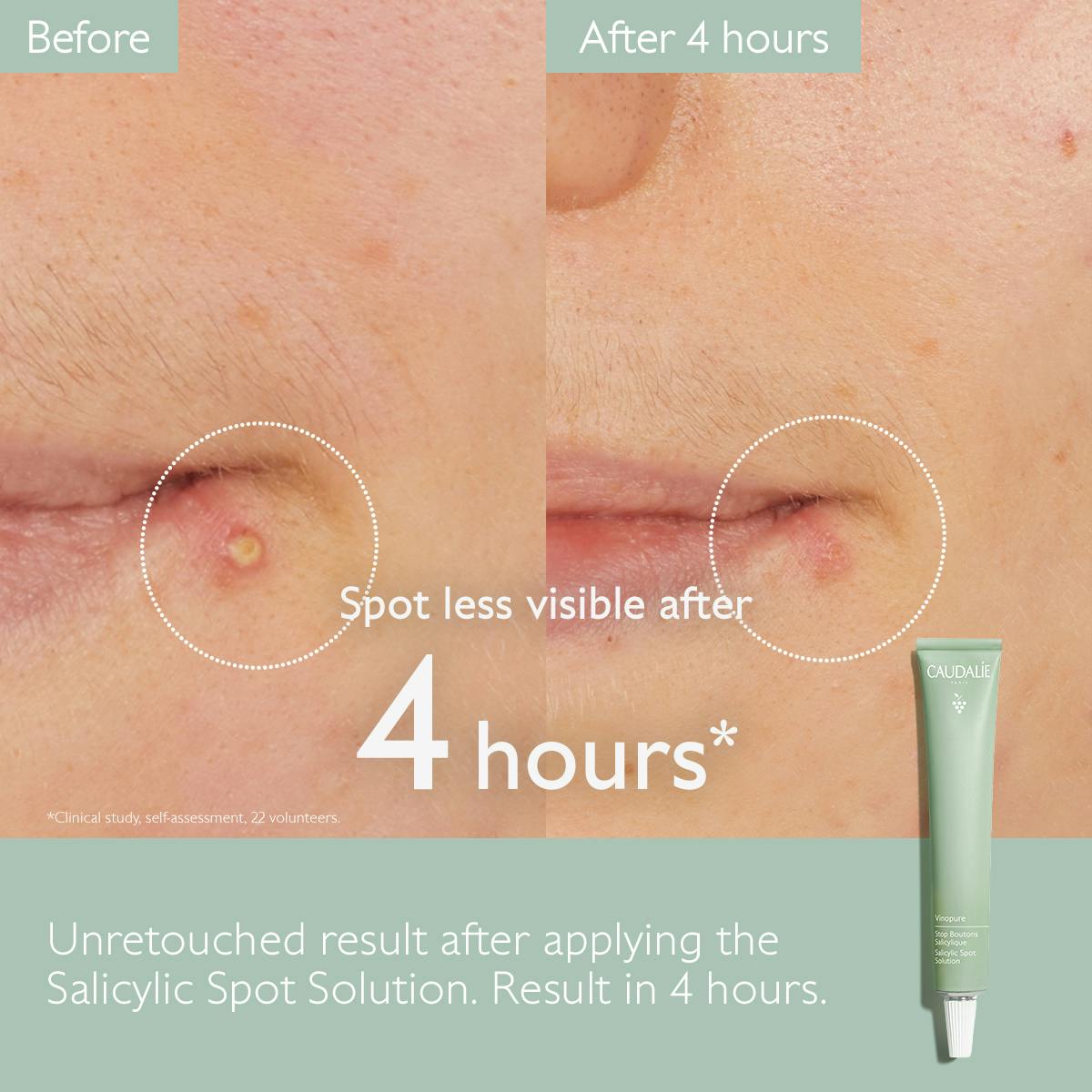 Caudalie Vinopure Salicylic Spot Solution